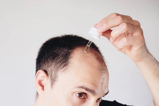 applying-anti-hair-loss-concentrate-serum-Hair-Serum-ss-body | Male Pattern Baldness: Causes, Symptoms & Treatment