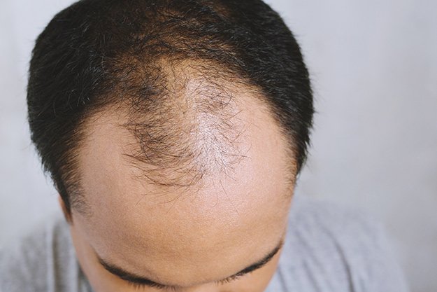 man-concerned-with-serious-hair-loss-What-Are-the-Symptoms-of-Male-Pattern-Baldness-ss-body | Male Pattern Baldness: Causes, Symptoms & Treatment