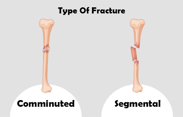 Comminuted-Fractures-and-Segmental-Fractures