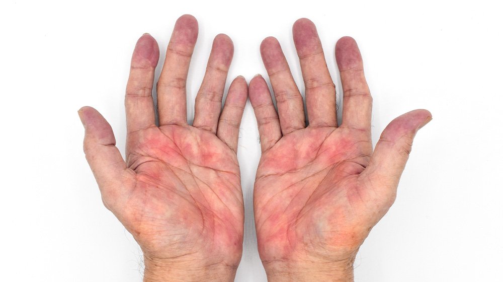 PH-Palmar erythema often called liver palms in both hands-ss-What Causes Palmar Erythema and What Does It Mean for Your Health