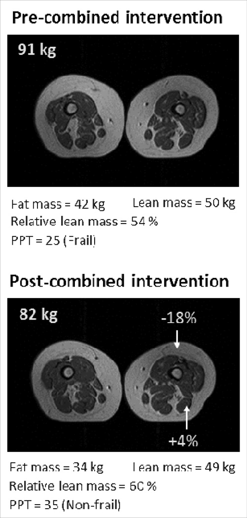 Fat and lean mass changes following combined weight loss and exercise interventions. Source: Current Opinion in Endocrinology, Diabetes, and Obesity.
