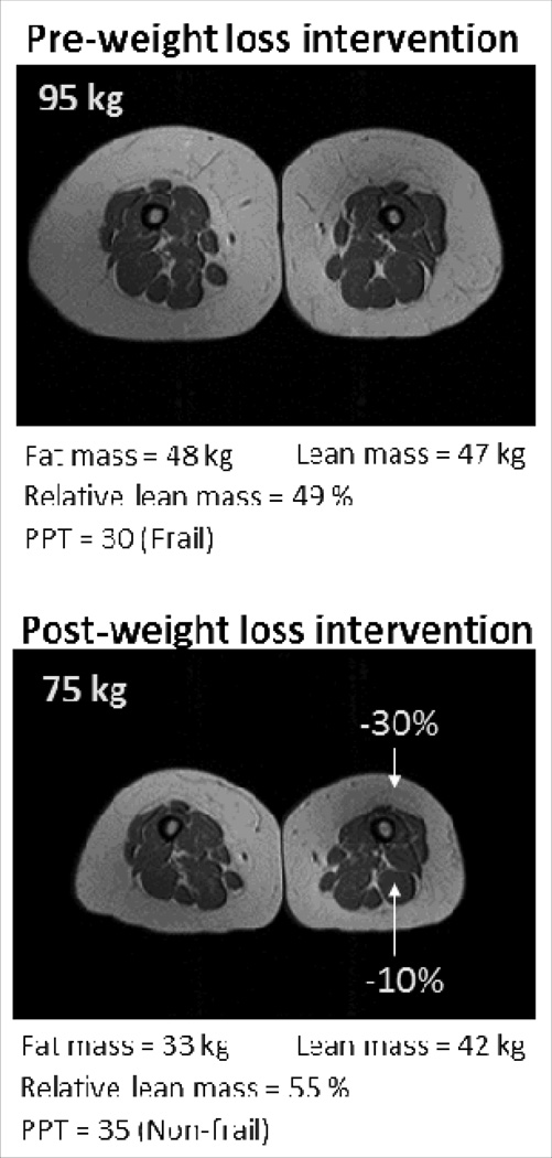 Fat and lean mass changes following weight loss interventions. Source: Current Opinion in Endocrinology, Diabetes, and Obesity.